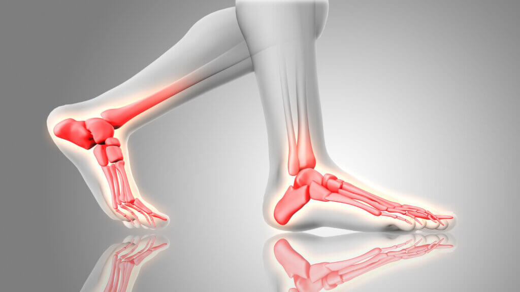 Foot injury caused by running a marathon